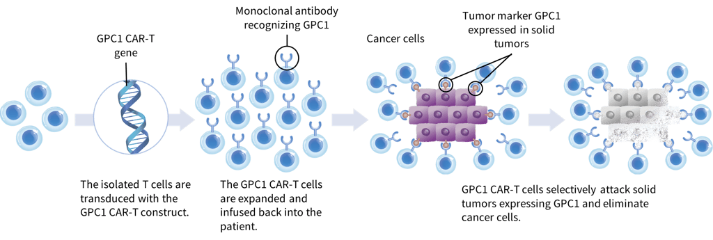 Clinical Pipeline - GPC1 CAR-T therapy Clinical Pipeline - GPC1 CAR-T therapy